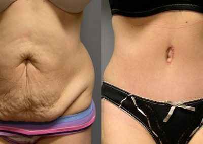 Trimmed Waistline: Before-and-after snapshots illustrating the effects of liposuction on the abdominal and waist regions