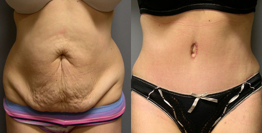 Abdominoplasty with Liposuction