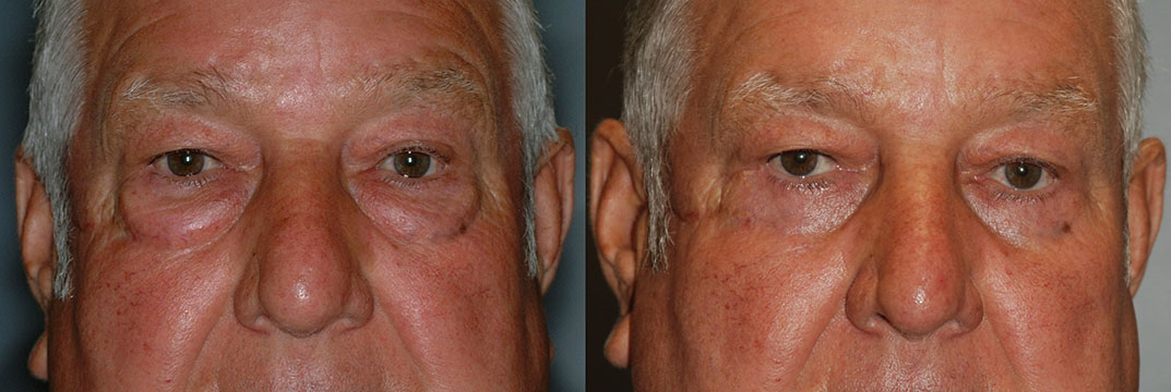 Comparative images documenting the effects of Blepharoplasty on a man's facial appearance