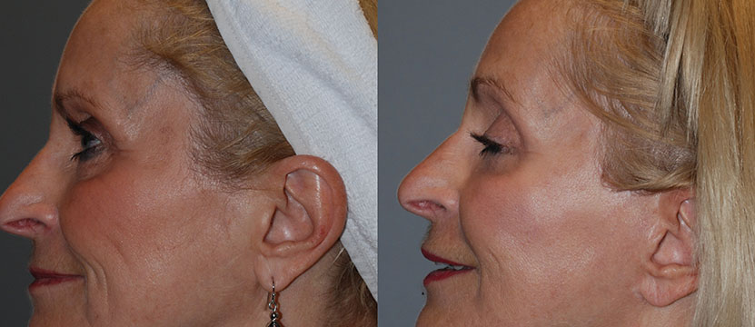 The before and after transformation of a woman's face with Blepharoplasty