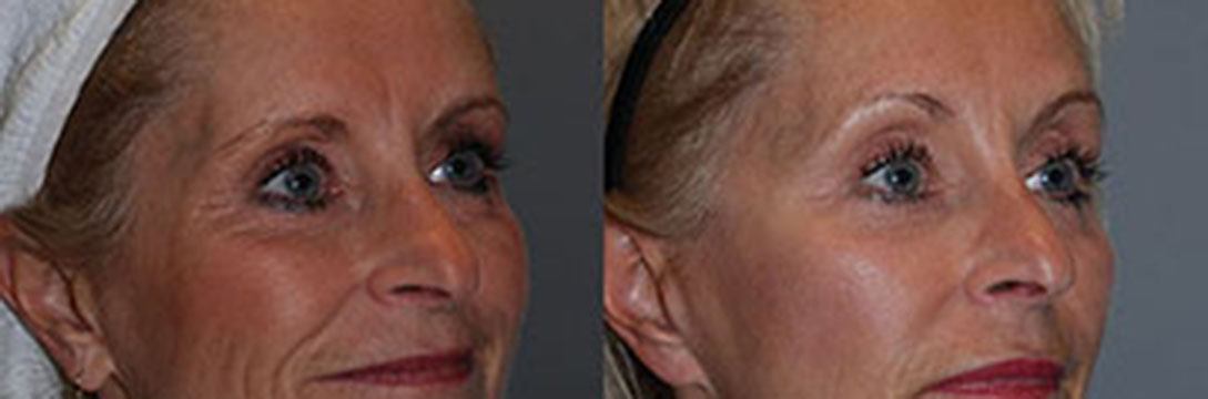 Facial enhancement outcomes documented through before and after Blepharoplasty photos