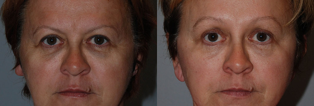 Before and after snapshots revealing the results of Blepharoplasty surgery