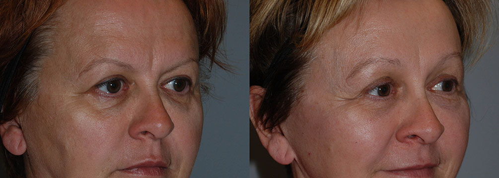 Comparative visuals showcasing the cosmetic benefits of Blepharoplasty