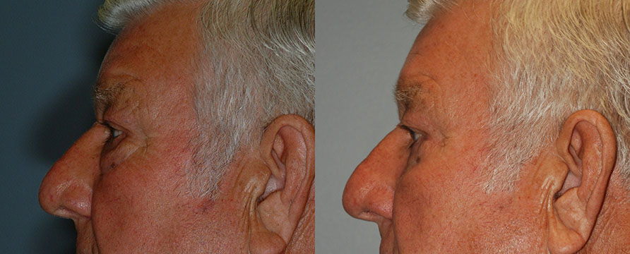 Transformation of a man's face before and after Blepharoplasty procedure
