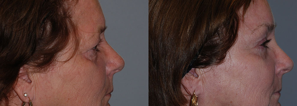Visual transformation of a woman's face following Blepharoplasty