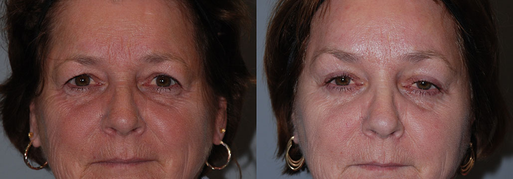 Evolution of facial appearance with before and after Blepharoplasty images