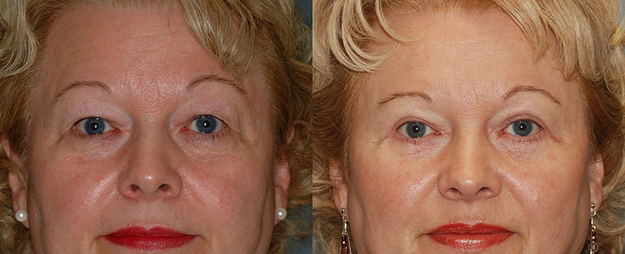 A comparison of a woman's face before and after Blepharoplasty surgery