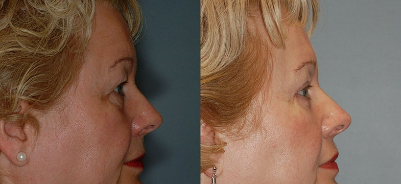 The visual evidence of a woman's facial rejuvenation journey with Blepharoplasty