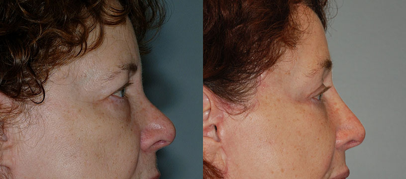 Evolutionary images showcasing a woman's facial changes post Blepharoplasty