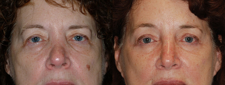 The cosmetic improvements in a woman's face after Blepharoplasty, documented in images