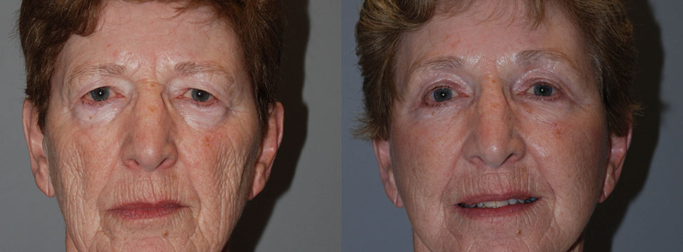 Two photos depicting a woman's facial evolution following Blepharoplasty
