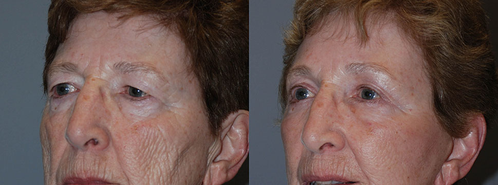 Transformational visuals of a woman's facial features before and after Blepharoplasty