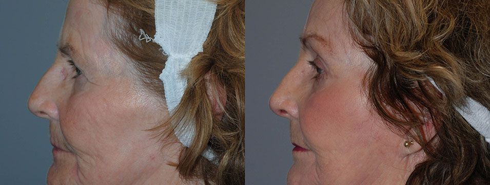The visual timeline of a woman's facial refinement journey after Blepharoplasty