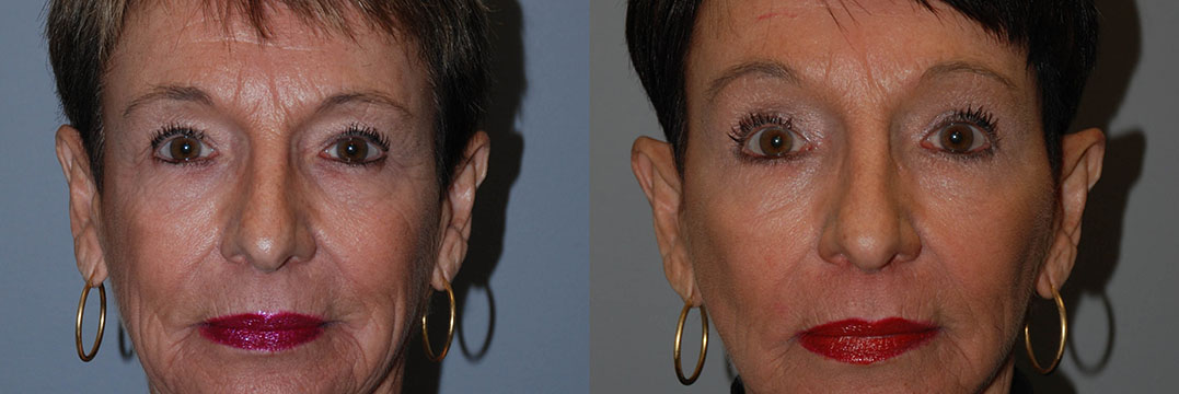 The visual timeline of a woman's facial refinement journey with Blepharoplasty