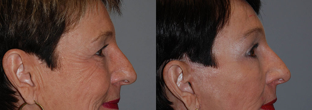 Before and after snapshots of a woman's facial contouring with Blepharoplasty