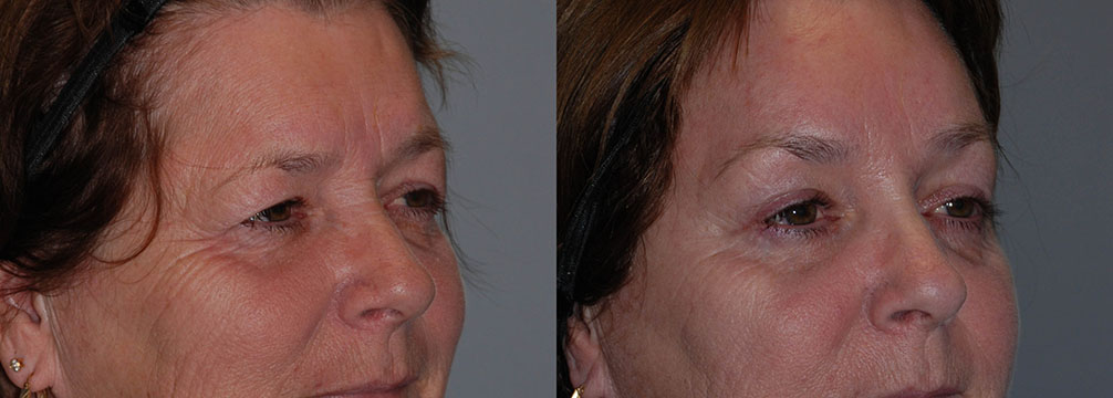 Aesthetic improvements in facial contouring seen in before and after Blepharoplasty images