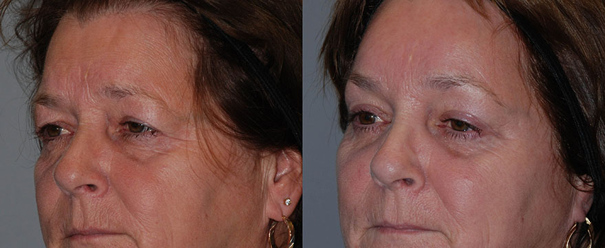 Transformational changes in a woman's facial features post Blepharoplasty