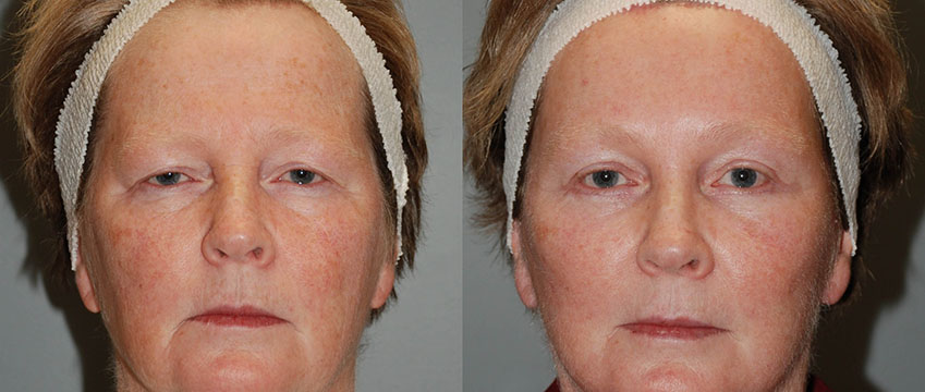 Before and after photos illustrating the outcome of Blepharoplasty surgery