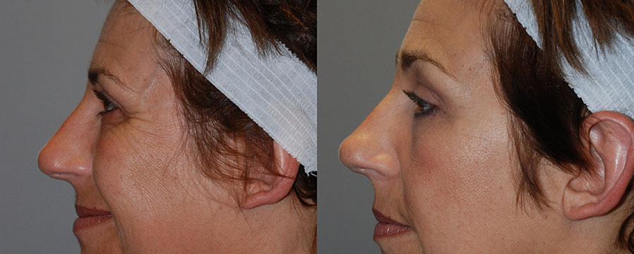 The cosmetic enhancements achieved through Blepharoplasty, documented visually
