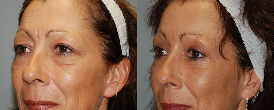 Facial rejuvenation journey captured in two photos, pre and post Blepharoplasty