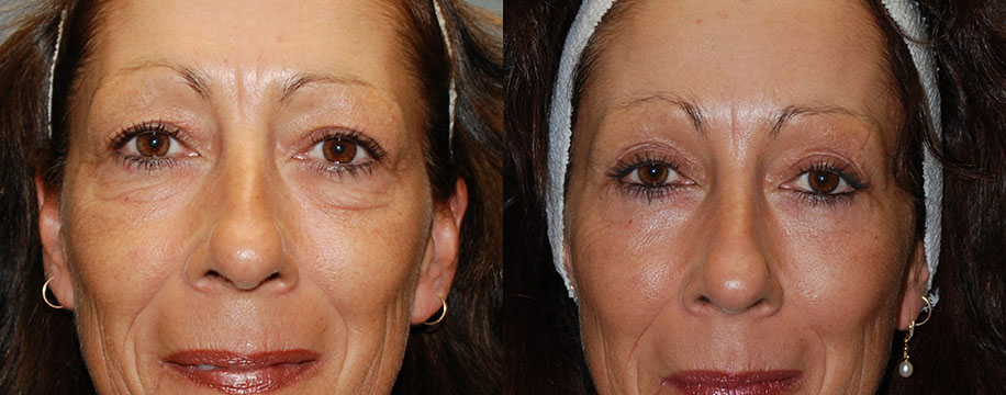 Before and after snapshots depicting the effects of Blepharoplasty on a woman's face