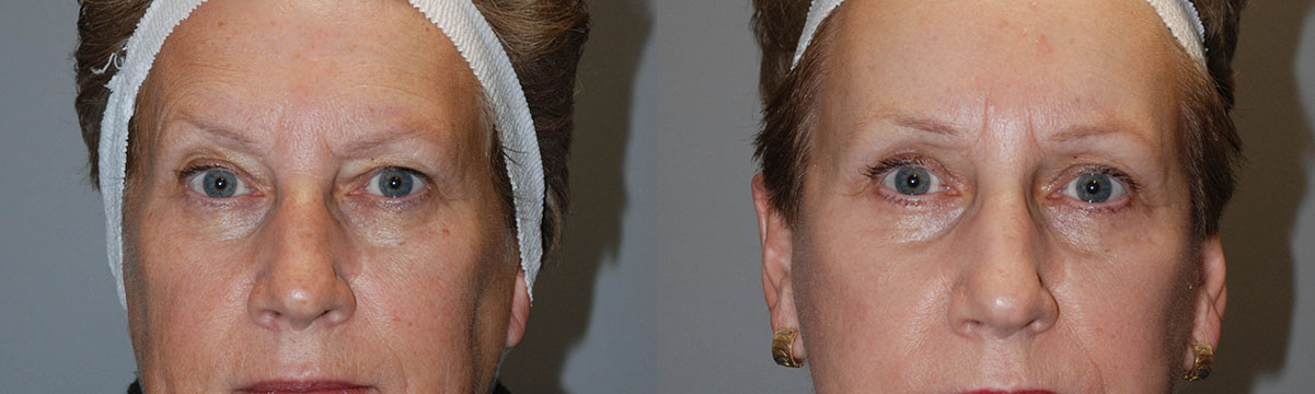 Facial enhancement outcomes achieved through Blepharoplasty, shown in before and after images