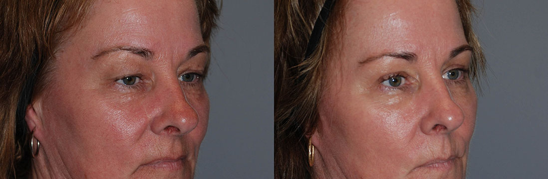 Comparison photos of a female's facial transformation pre and post Blepharoplasty