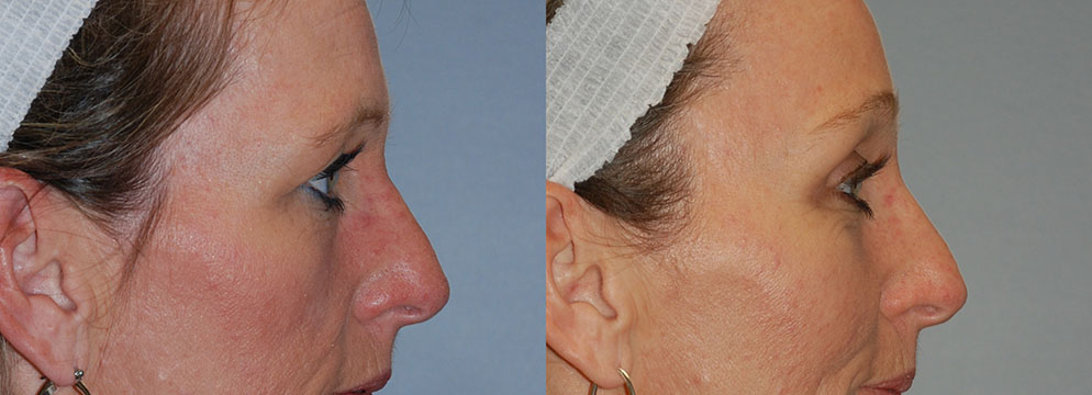 Aesthetic changes observed in a woman's face post Blepharoplasty, captured in two photos