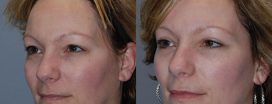 Comparative images illustrating the effects of Blepharoplasty on a woman's face