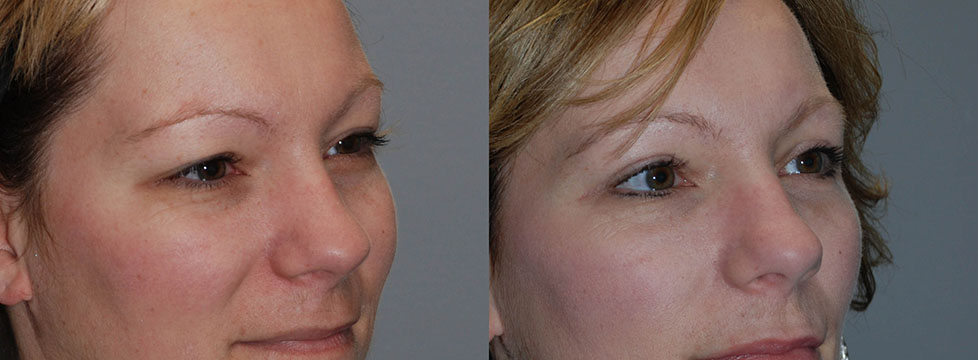 The progression of a woman's facial appearance before and after Blepharoplasty