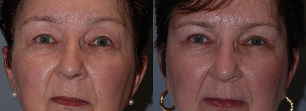 A woman's facial enhancement journey through Blepharoplasty, depicted in two photos