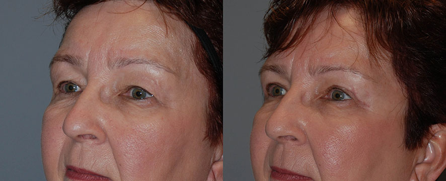 Transformational snapshots of a woman's face following Blepharoplasty