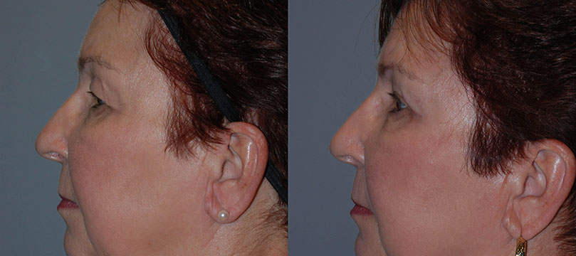 Images showing the evolution of a woman's face with Blepharoplasty