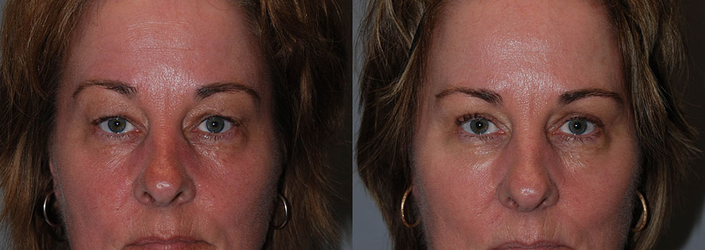 Visual depiction of a woman's facial changes before and after Blepharoplasty