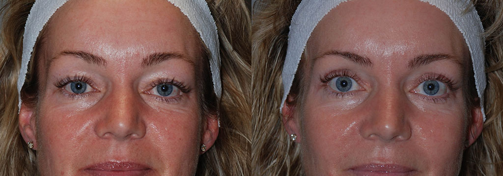 Before and after images of a woman's face undergoing Blepharoplasty