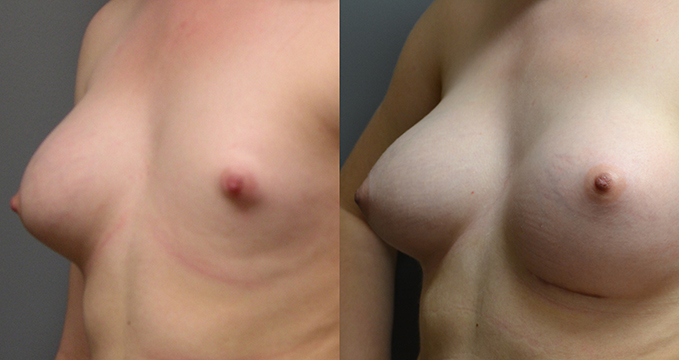 Breast Asymmetry Correction
