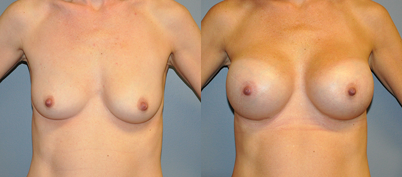 Breast Augmentation, Submuscular, Mentor HP, Cohesive Gel I Siltex 425