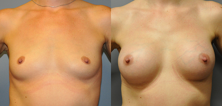 Breast Augmentation, Submuscular, Mentor HP, Cohesive Gel I, Siltex 350