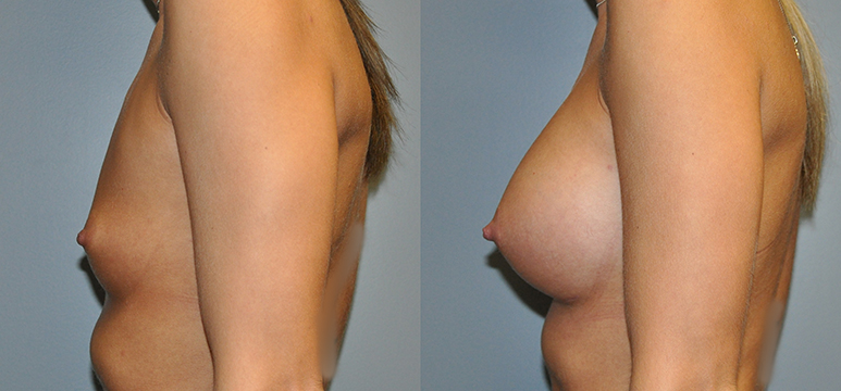 Breast Augmentation, Submuscular, Mentor HP, Cohesive Gel I, Siltex 350