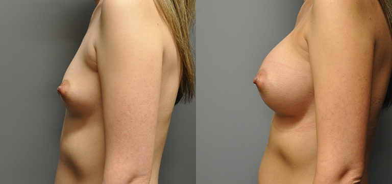Breast Augmentation, Submuscular, Mentor HP, Cohesive Gel I, Siltex 400