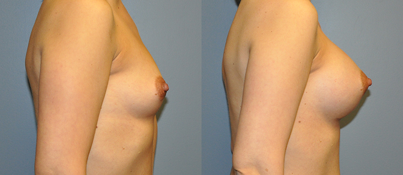 Breast Augmentation, Submuscular, Mentor HP, Cohesive Gel I, Siltex 275