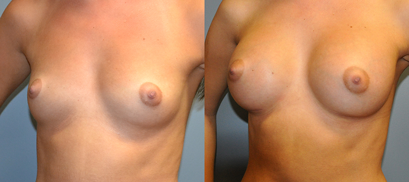 Breast Augmentation, Submuscular, Mentor HP, Cohesive Gel I, Siltex 275