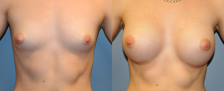 Breast Augmentation, Submuscular, Mentor HP, Cohesive Gel I, Siltex 300