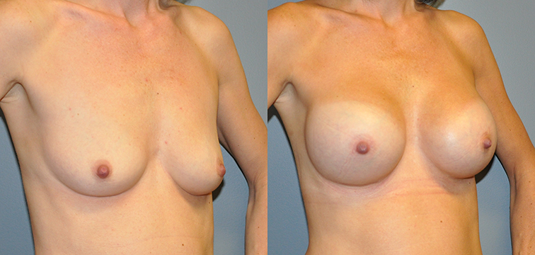 Breast Augmentation, Submuscular, Mentor HP, Cohesive Gel I, Siltex 325