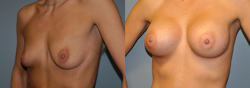 Breast Augmentation, Submuscular, Mentor HP, Cohesive Gel I, Siltex 325 (L) 350 (R)