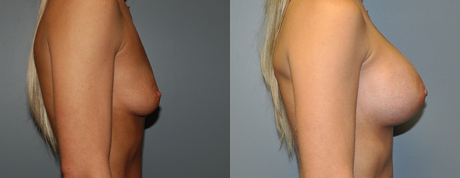 Breast Augmentation, Submuscular, Mentor HP, Cohesive Gel I, Siltex 325 (L) 350 (R)