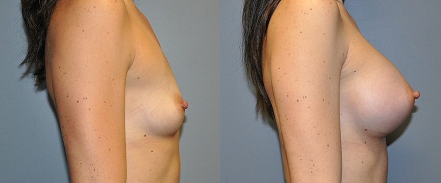 Breast Augmentation, Submuscular, Mentor HP, Cohesive Gel I, Siltex 375