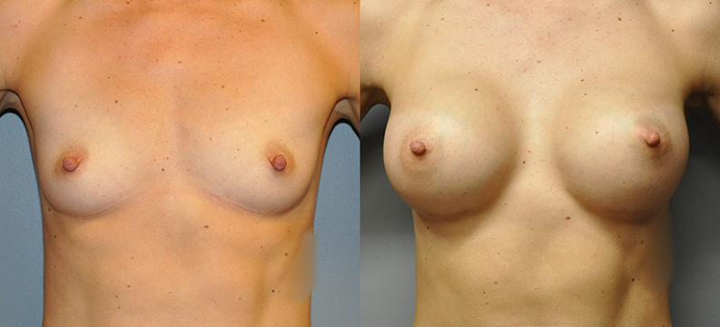 Breast Augmentation, Submuscular, Mentor HP, Cohesive Gel I, Siltex 375