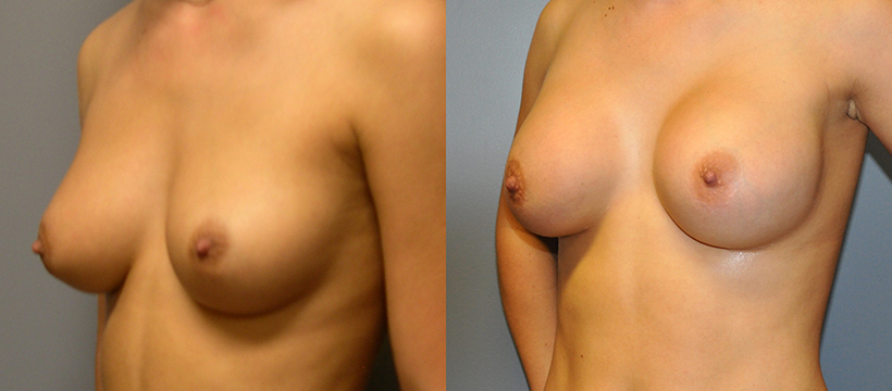 Breast Augmentation, Submuscular, Mentor HP, Cohesive Gel I, Siltex 375(left), Mentor MPP, Cohesive Gel I, Siltex 275 (right)