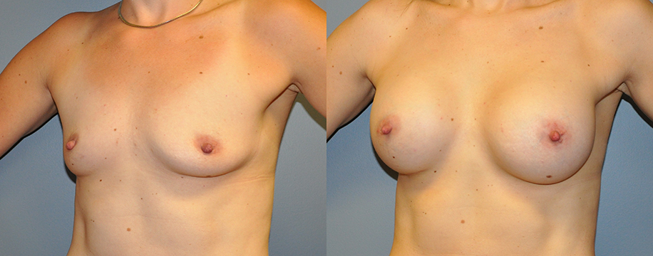 Breast Augmentation, Submuscular, Mentor HP, Cohesive Gel I, Siltex 400